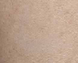 Burn scar, after KELOSCAR BIOGEL use