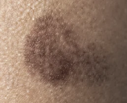 Burn scar, before KELOSCAR BIOGEL use