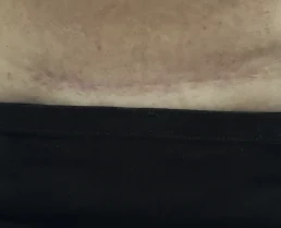 C-section scar, after KELOSCAR BIOGEL use