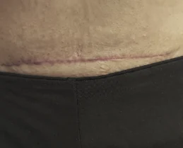 C-section scar, before KELOSCAR BIOGEL use