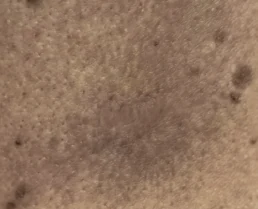 Hypertrophic scar, after KELOSCAR BIOGEL use