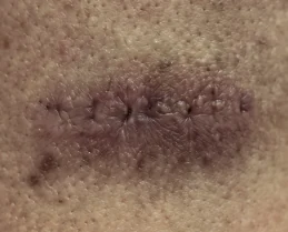 Hypertrophic scar, before KELOSCAR BIOGEL use