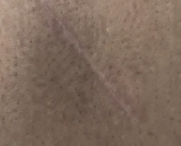 Lipoma surgery scar, after KELOSCAR BIOGEL use