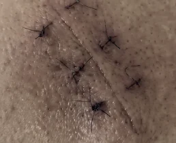 Lipoma surgery scar, before KELOSCAR BIOGEL use