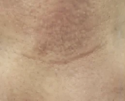 Thyroidectomy scar, after KELOSCAR BIOGEL use