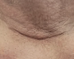 Thyroidectomy scar, before KELOSCAR BIOGEL use