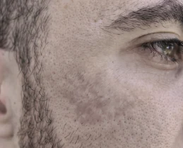 Traumatic injury scar, after KELOSCAR BIOGEL use