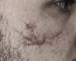 Traumatic injury scar, before KELOSCAR BIOGEL use