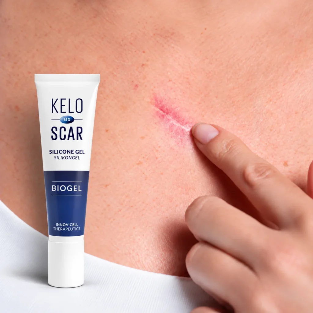 A KELOSCAR BIOGEL tube next to a healed scar near the collarbone