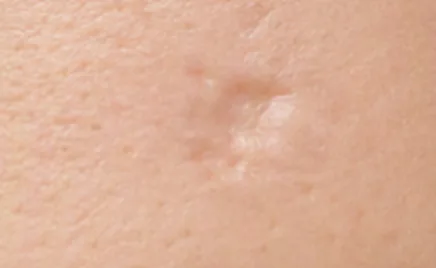 Illustrative example of an atrophic scar: a small depressed area of skin