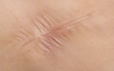 Illustrative example of a contracture scar: tight, puckered skin