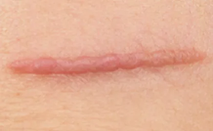 Illustrative example of a hypertrophic scar: a raised red line within the wound edges