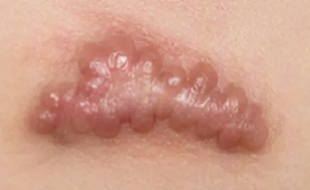 Illustrative example of a keloid scar: a raised, irregular scar extending beyond the wound
