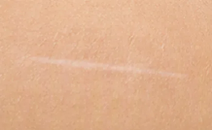 Illustrative example of a mature linear scar: a flat, pale line