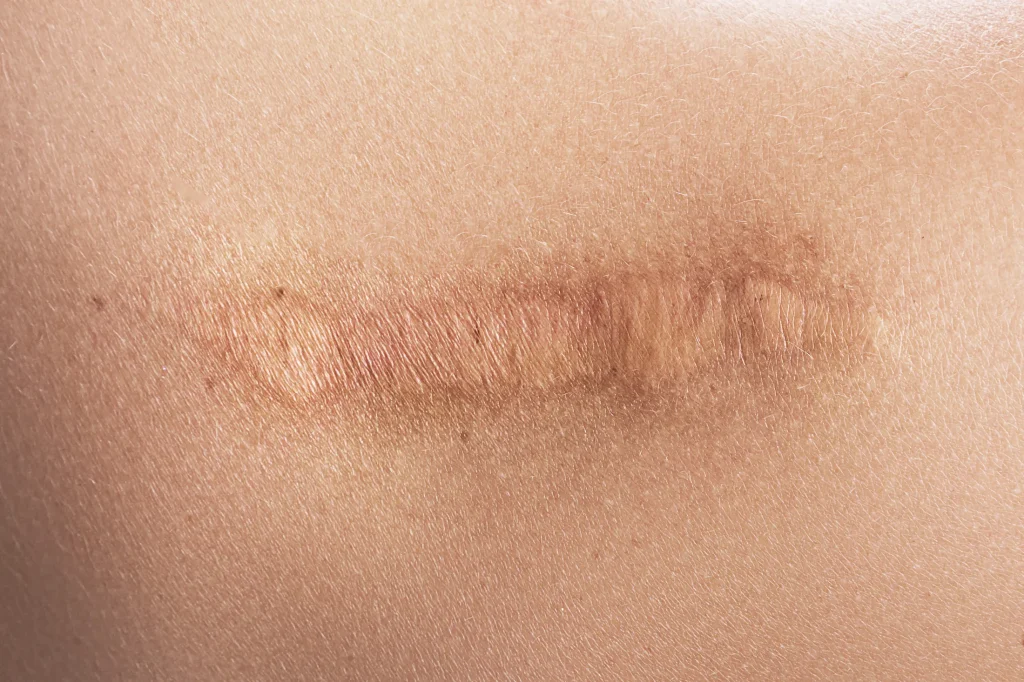 A healed surgical scar on the shoulder